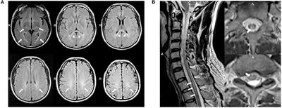 Novel GALC Mutations Cause Adult-Onset Krabbe Disease With Myelopathy in Two Chinese Families: Case Reports and Literature Review